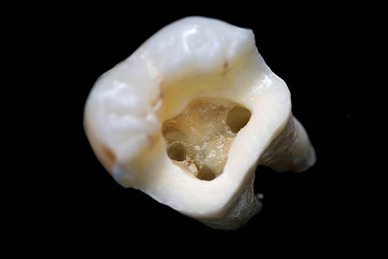 Root Canal Treatments